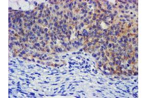 Immunohistochemical staining of paraffin-embedded Adenocarcinoma of Human ovary tissue using anti-PLDN mouse monoclonal antibody. (Pallidin anticorps)