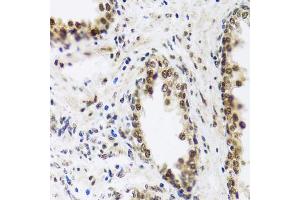 Immunohistochemistry of paraffin-embedded human prostate using SAFB2 antibody (ABIN5972429) at dilution of 1/100 (40x lens). (SAFB2 anticorps)