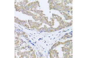 Immunohistochemistry of paraffin-embedded human liver cancer using TIMM10B antibody at dilution of 1:100 (x40 lens). (TIMM10B anticorps)