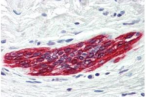Human Breast (formalin-fixed, paraffin-embedded) stained with DAPK2 antibody ABIN214481 at 5 ug/ml followed by biotinylated goat anti-rabbit IgG secondary antibody ABIN481713, alkaline phosphatase-streptavidin and chromogen. (DAPK2 anticorps  (C-Term))