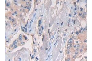 Detection of CD74 in Human Breast cancer Tissue using Polyclonal Antibody to Cluster Of Differentiation 74 (CD74)