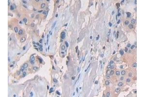 Detection of CD74 in Human Breast cancer Tissue using Polyclonal Antibody to Cluster Of Differentiation 74 (CD74) (CD74 anticorps  (AA 78-222))