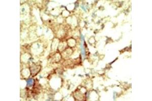 IHC analysis of FFPE human breast carcinoma tissue stained with the RET antibody (Ret Proto-Oncogene anticorps  (AA 1012-1042))