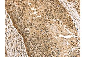 The image on the left is immunohistochemistry of paraffin-embedded Human esophagus cancer tissue using ABIN7131203(STAG2 Antibody) at dilution 1/35, on the right is treated with fusion protein. (STAG2 anticorps)