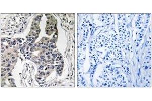 Immunohistochemistry analysis of paraffin-embedded human breast carcinoma, using Vimentin (Phospho-Ser83) Antibody.