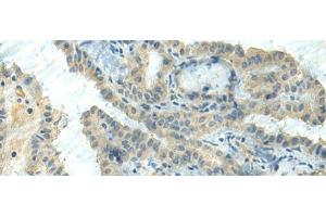 Immunohistochemistry of paraffin-embedded Human thyroid cancer tissue using CTDP1 Polyclonal Antibody at dilution of 1:55(x200) (CTDP1 anticorps)