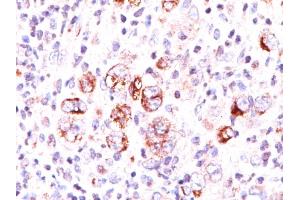 Formalin-fixed, paraffin-embedded Hodgkin's lymphoma stained with Bcl-x Mouse Monoclonal Antibody (2H12).