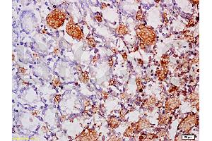 Formalin-fixed and paraffin embedded human gastric carcinoma labeled Anti-MAdCAM-1 Polyclonal Antibody, Unconjugated at 1:200, followed by conjugation to the secondary antibody and DAB staining (MADCAM1 anticorps  (AA 151-250))
