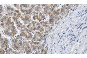 ABIN6269382 at 1/100 staining Human liver cancer tissue by IHC-P.