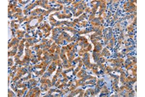 The image on the left is immunohistochemistry of paraffin-embedded Human thyroid cancer tissue using ABIN7128355(ALG12 Antibody) at dilution 1/20, on the right is treated with fusion protein. (ALG12 anticorps)