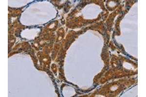 The image on the left is immunohistochemistry of paraffin-embedded Human thyroid cancer tissue using ABIN7130584(PEF1 Antibody) at dilution 1/20, on the right is treated with fusion protein. (PEF1 anticorps)