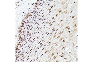 Immunohistochemistry of paraffin-embedded human esophageal using MLF2 antibody (ABIN7268725) at dilution of 1:100 (40x lens). (MLF2 anticorps  (AA 1-65))