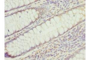 Immunohistochemistry of paraffin-embedded human colon cancer using ABIN7142221 at dilution of 1:100
