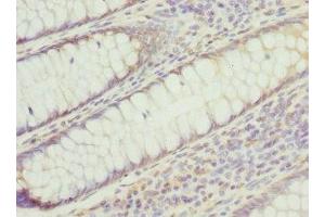 Immunohistochemistry of paraffin-embedded human colon cancer using ABIN7142221 at dilution of 1:100 (PSMD8 anticorps  (Regulatory Subunit 8))