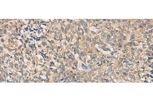 Immunohistochemistry of paraffin-embedded Human cervical cancer tissue using CMTM4 Polyclonal Antibody at dilution of 1:55(x200)