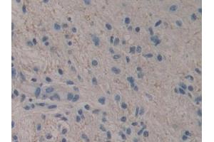 Detection of RSPO3 in Human Glioma Tissue using Polyclonal Antibody to R-Spondin 3 (RSPO3)