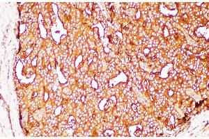Immunohistochemistry of paraffin-embedded Human prostate cancer using FOLH1 Polycloanl Antibody at dilution of 1:200 (PSMA anticorps)