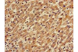 Immunohistochemistry of paraffin-embedded human liver cancer using ABIN7150673 at dilution of 1:100 (TGDS anticorps  (AA 143-305))