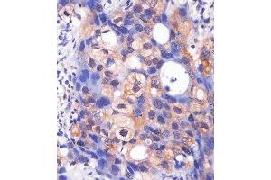 (ABIN6243071 and ABIN6577240) staining PK3/1 in hun breast carcino sections by Immunohistochemistry (IHC-P - paraforldehyde-fixed, paraffin-embedded sections).