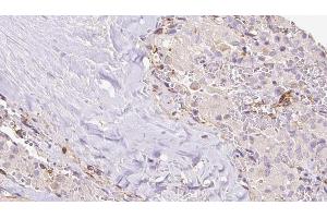 ABIN6273309 at 1/100 staining Human thyroid cancer tissue by IHC-P. (RIC8B anticorps  (C-Term))