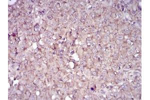 Immunohistochemical analysis of paraffin-embedded endometrial cancer tissues using CD38 mouse mAb with DAB staining. (CD38 anticorps  (AA 43-300))
