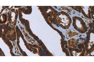 Immunohistochemistry of paraffin-embedded Human thyroid cancer using FASTKD2 Polyclonal Antibody at dilution of 1:45 (FASTKD2 anticorps)