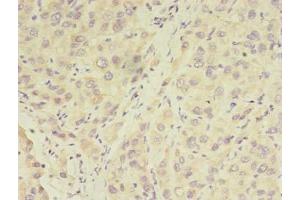 Immunohistochemistry of paraffin-embedded human liver cancer using ABIN7175887 at dilution of 1:100 (RPGR anticorps  (AA 1-180))