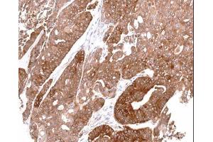 IHC-P Image Immunohistochemical analysis of paraffin-embedded gastric N87 xenograft, using ALDH1A1, antibody at 1:100 dilution.