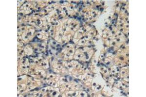 IHC-P analysis of kidney cancer tissue, with DAB staining. (IL12RB2 anticorps  (AA 145-275))