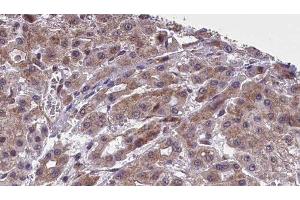 ABIN6277402 at 1/100 staining Human liver cancer tissue by IHC-P. (SLC16A4 anticorps  (Internal Region))