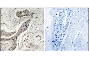 Immunohistochemistry analysis of paraffin-embedded human breast carcinoma, using BCL-XL (Phospho-Thr115) Antibody.