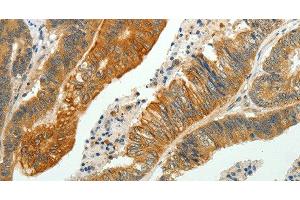 Immunohistochemistry of paraffin-embedded Human colon cancer using SH-PTP1 Polyclonal Antibody at dilution of 1:35 (SHP1 anticorps)