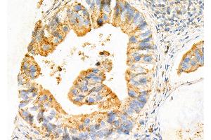 ABIN6257124 and ABIN6275080 at 1/100 staining Human pancreatic cancer by IHC-P.