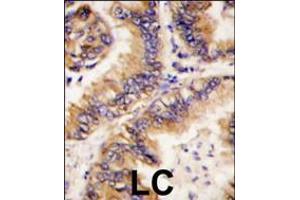 Formalin-fixed and paraffin-embedded human lung carcinoma tissue reacted with TRAPPC4 antibody , which was peroxidase-conjugated to the secondary antibody, followed by DAB staining. (TRAPPC4 anticorps  (N-Term))