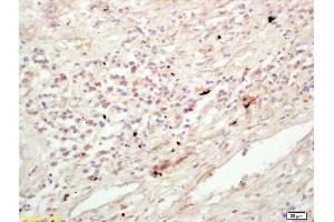 Formalin-fixed and paraffin embedded human lung carcinoma labeled with Rabbit Anti KIF11/Eg5/TRIP5 Polyclonal Antibody, Unconjugated (ABIN872373) at 1:200 followed by conjugation to the secondary antibody and DAB staining (K11 (AA 351-450) anticorps)