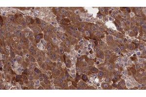 ABIN6277378 at 1/100 staining Human liver cancer tissue by IHC-P. (GRM8 anticorps  (C-Term))