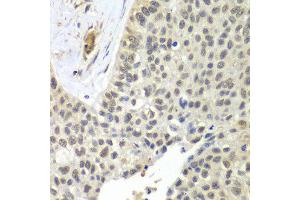 Immunohistochemistry of paraffin-embedded human lung cancer using SNRPD2 antibody at dilution of 1:100 (x40 lens). (SNRPD2 anticorps)