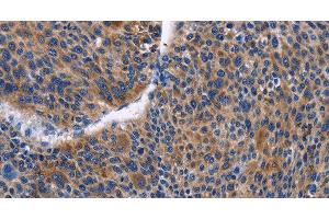 Immunohistochemistry of paraffin-embedded Human liver cancer tissue using IGSF10 Polyclonal Antibody at dilution 1:50 (IGSF10 anticorps)