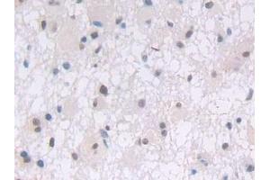 Detection of PLCg1 in Human Glioma Tissue using Polyclonal Antibody to Phospholipase C Gamma 1 (PLCg1)