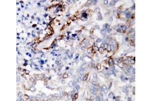 Anti-LAMC2 antibody, IHC(P): Human Lung Cancer Tissue (LAMC2 anticorps  (C-Term))