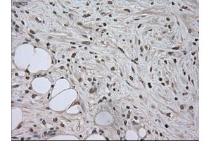 Immunohistochemical staining of paraffin-embedded Carcinoma of kidney tissue using anti-SATB1mouse monoclonal antibody. (SATB1 anticorps)