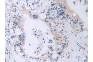 Detection of MAEA in Human Bile duct cancer Tissue using Polyclonal Antibody to Macrophage Erythroblast Attacher (MAEA)