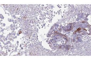 ABIN6273454 at 1/100 staining Human urothelial cancer tissue by IHC-P.