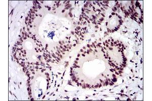 Immunohistochemical analysis of paraffin-embedded colon cancer tissues using CTNNBL1 mouse mAb with DAB staining.