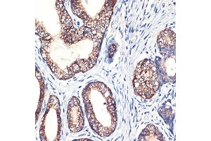 Immunohistochemistry of paraffin-embedded human prostate cancer using Arginase 2 (Arginase 2 ) Rabbit mAb (ABIN7265661) at dilution of 1:100 (40x lens).
