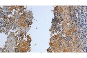 Immunohistochemistry of paraffin-embedded Human tonsil tissue using DLG4 Polyclonal Antibody at dilution 1:30 (DLG4 anticorps)