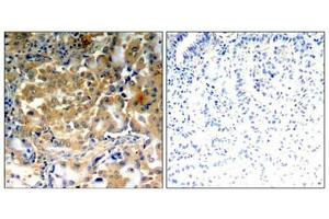 Immunohistochemical analysis of paraffin-embedded human lung carcinoma tissue using PKCζ (Phospho-Thr410) antibody. (PKC zeta anticorps  (pThr410))