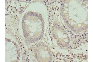 Immunohistochemistry of paraffin-embedded human colon cancer using ABIN7154629 at dilution of 1:100 (K-RAS anticorps  (AA 2-168))