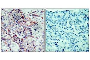 Immunohistochemical analysis of paraffin-embedded human breast carcinoma tissue using SEK1/MKK4(Phospho-Ser80) Antibody(left) or the same antibody preincubated with blocking peptide(right). (MAP2K4 anticorps  (pSer80))