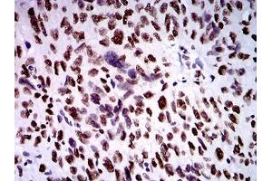 Immunohistochemical analysis of paraffin-embedded ovarian cancer tissues using ZFP91 mouse mAb with DAB staining. (ZFP91 anticorps  (AA 162-304))